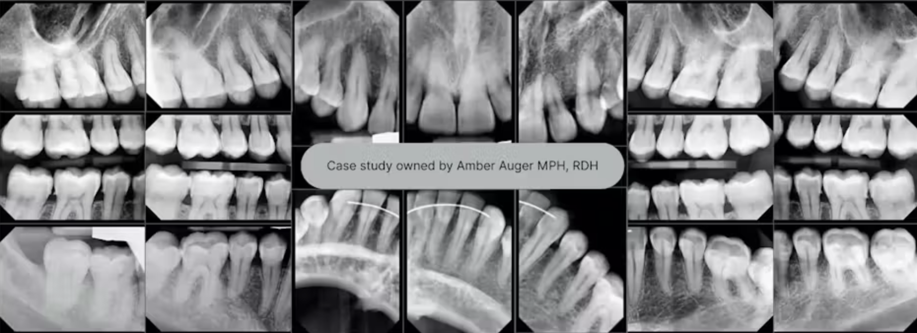 Case lâm sàng về cạo vôi kết hợp đánh bóng bằng bột glycine